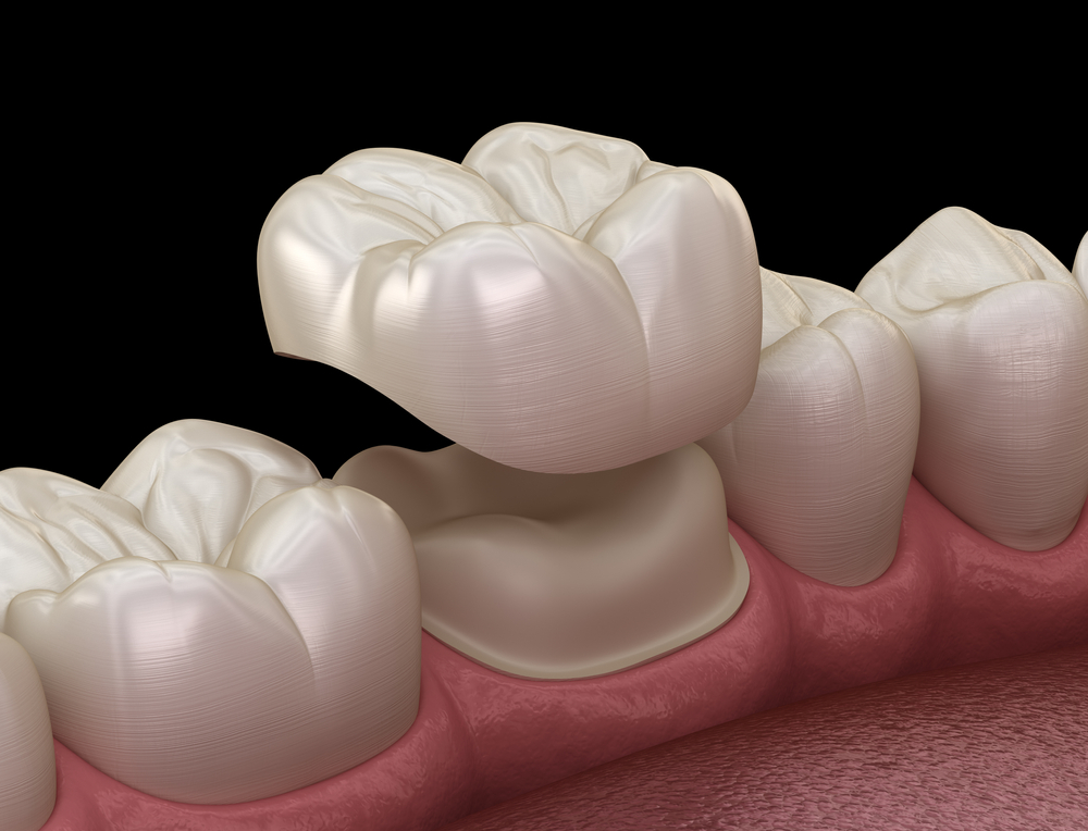 dental crowns, tooth crown grand prairie tx