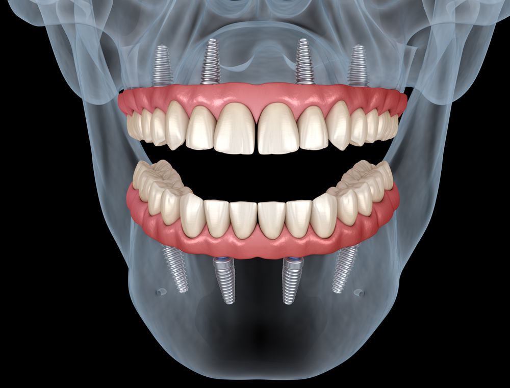 dental implants grand prairie tx