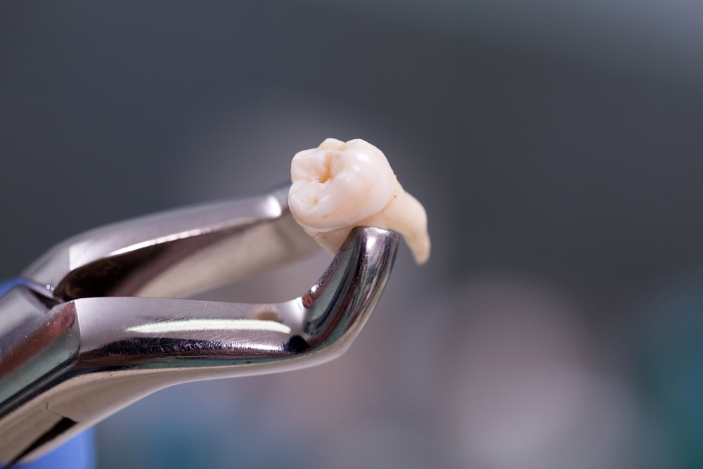 Tooth Extraction Grand Prairie TX