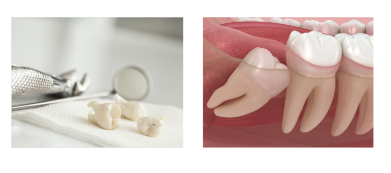 Wisdom Teeth Issues Wisdom Teeth Extraction Cost in Kondhwa: Procedure, Factors, and ...