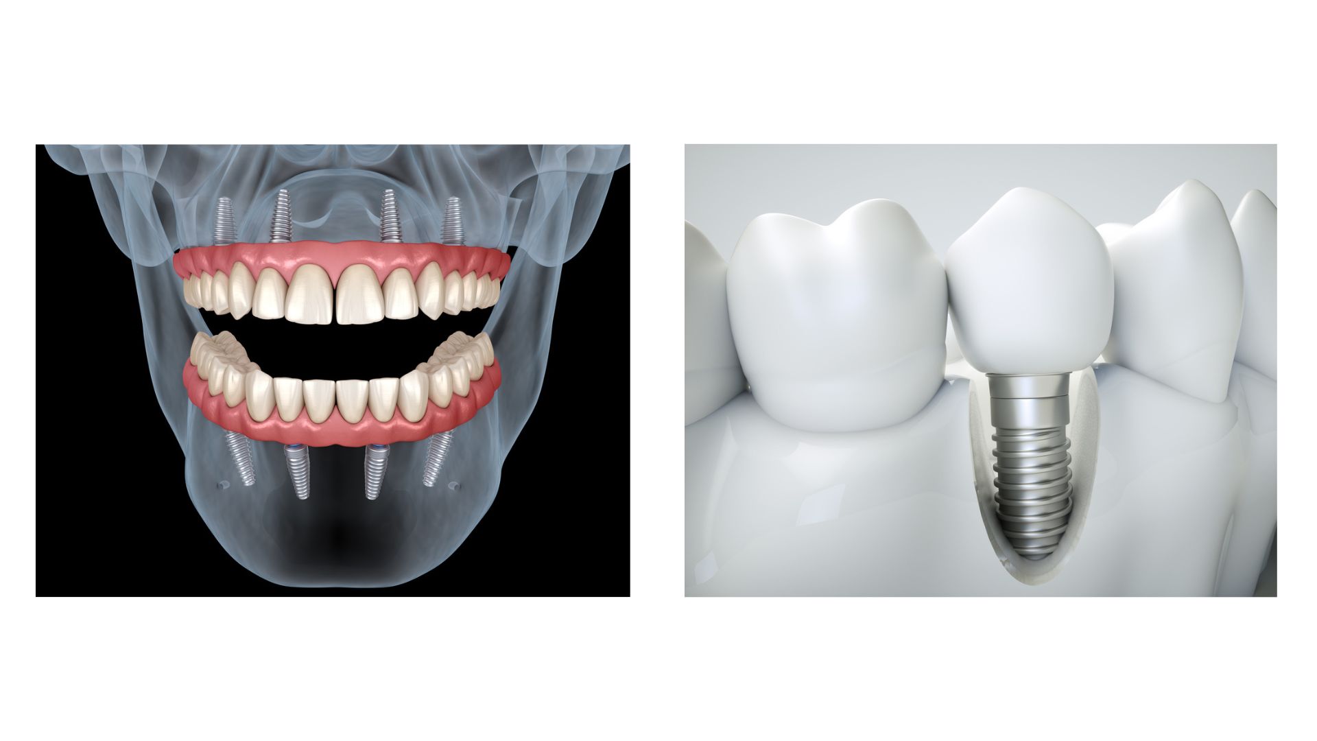 types of dental implants