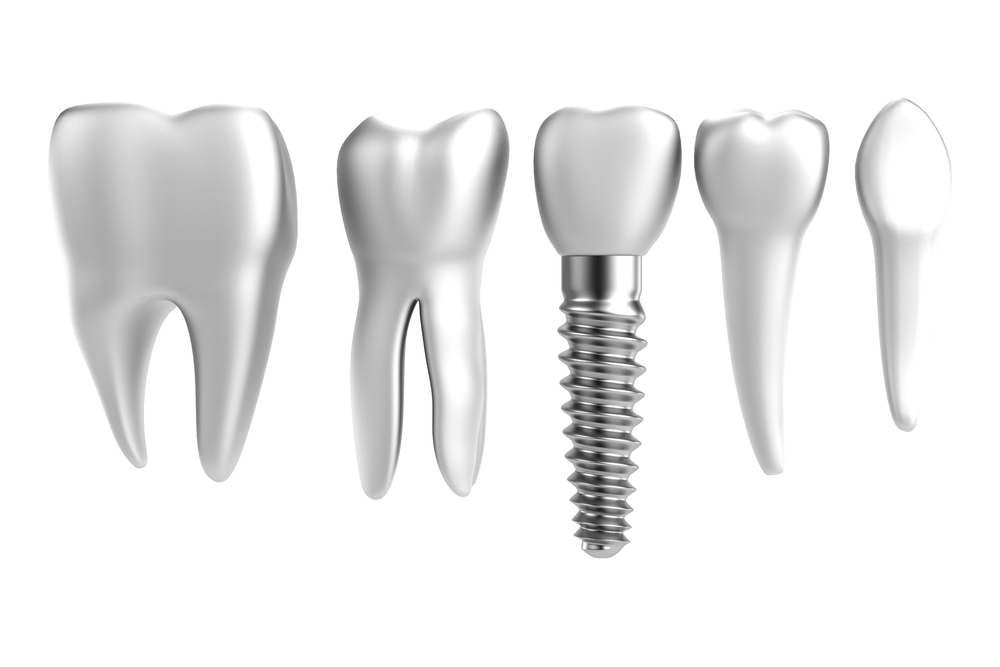 dental implants vs crowns