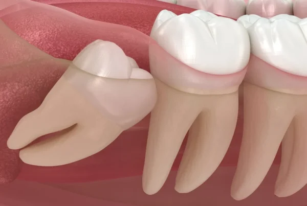 wisdom tooth extraction cost in grand prairie tx