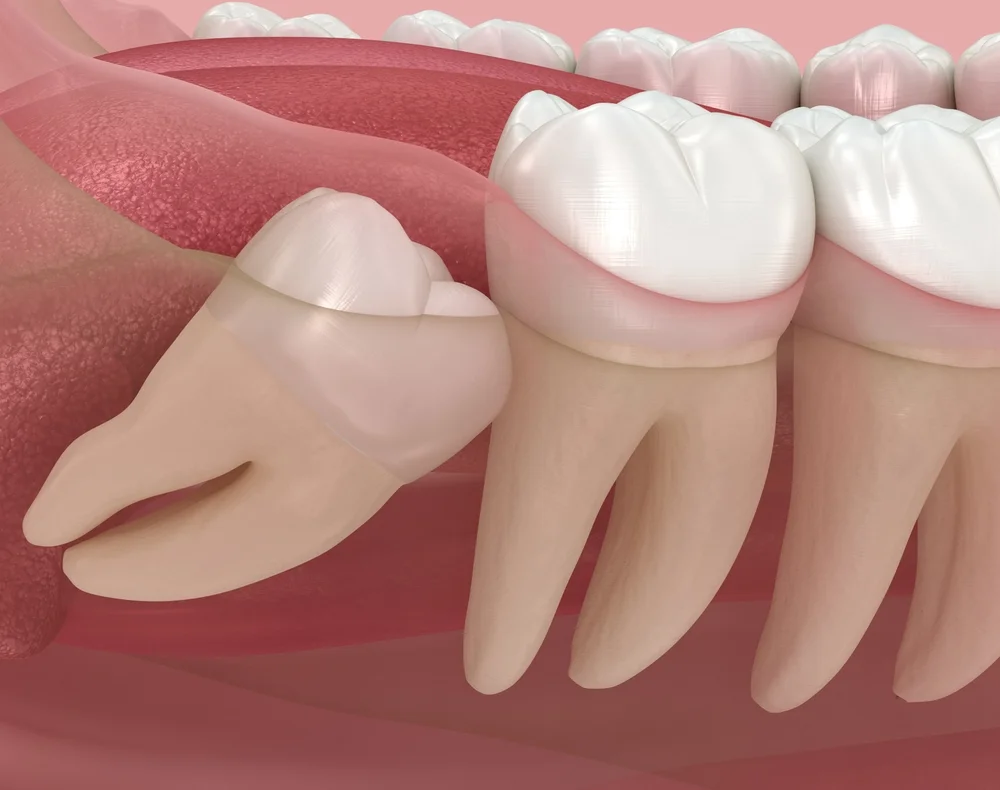 wisdom tooth extraction cost in grand prairie tx