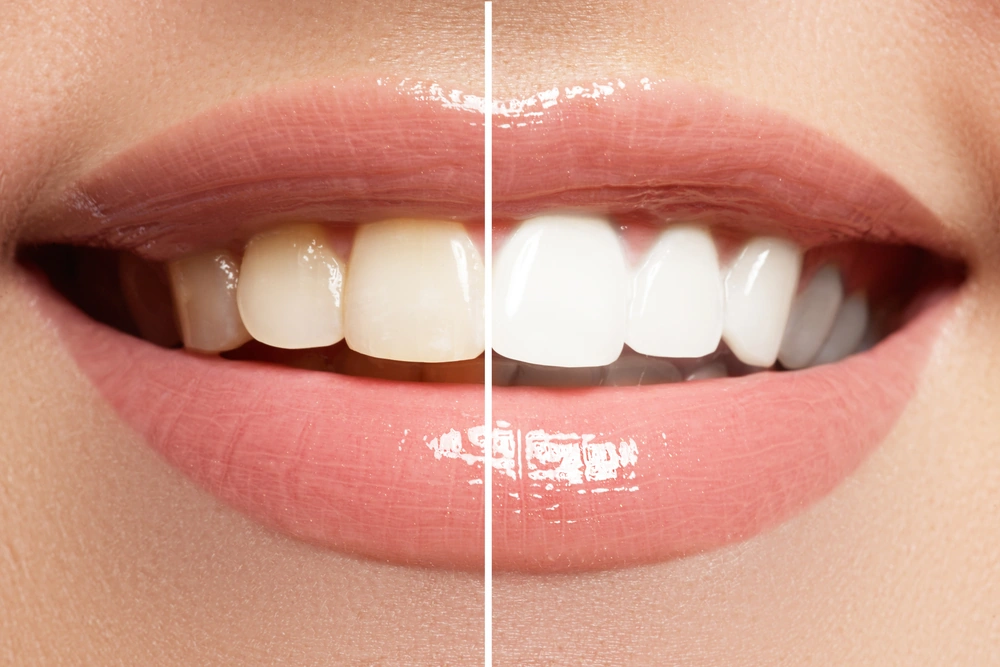 The Power of Take-Home Whitening Kits