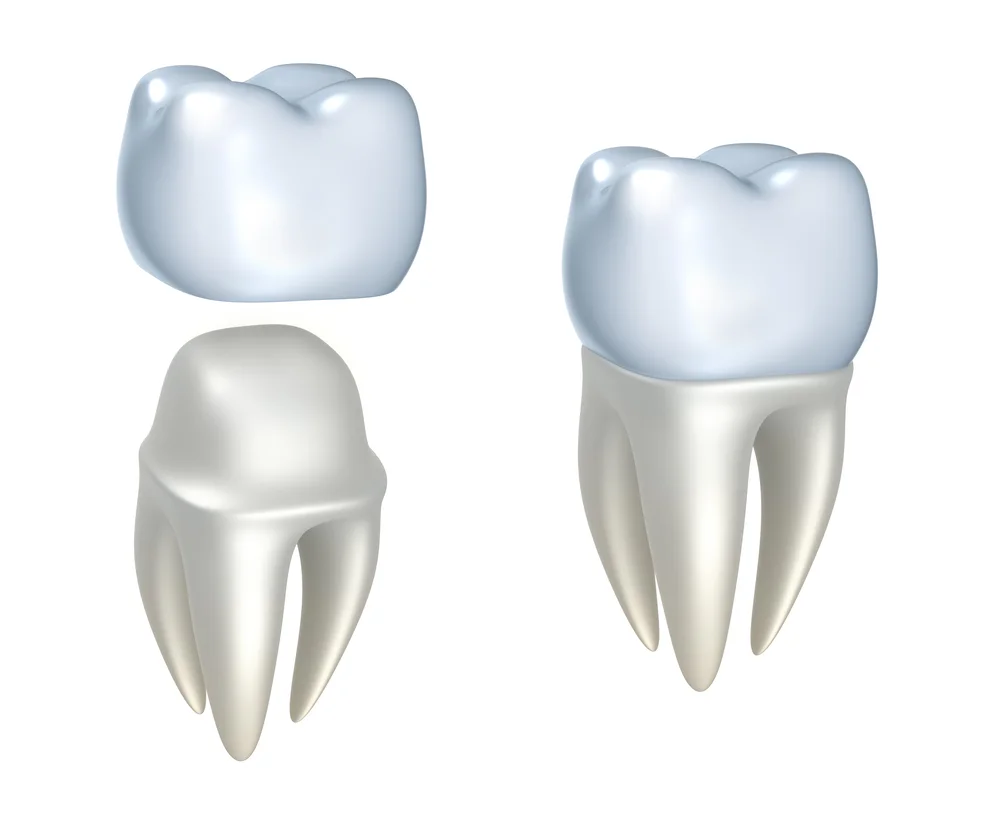 Types of Dental Crowns: Pros and Cons