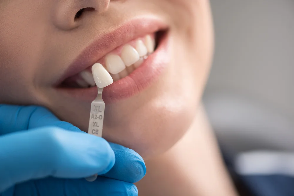The Science Behind Teeth Bleach in Grand Prairie TX