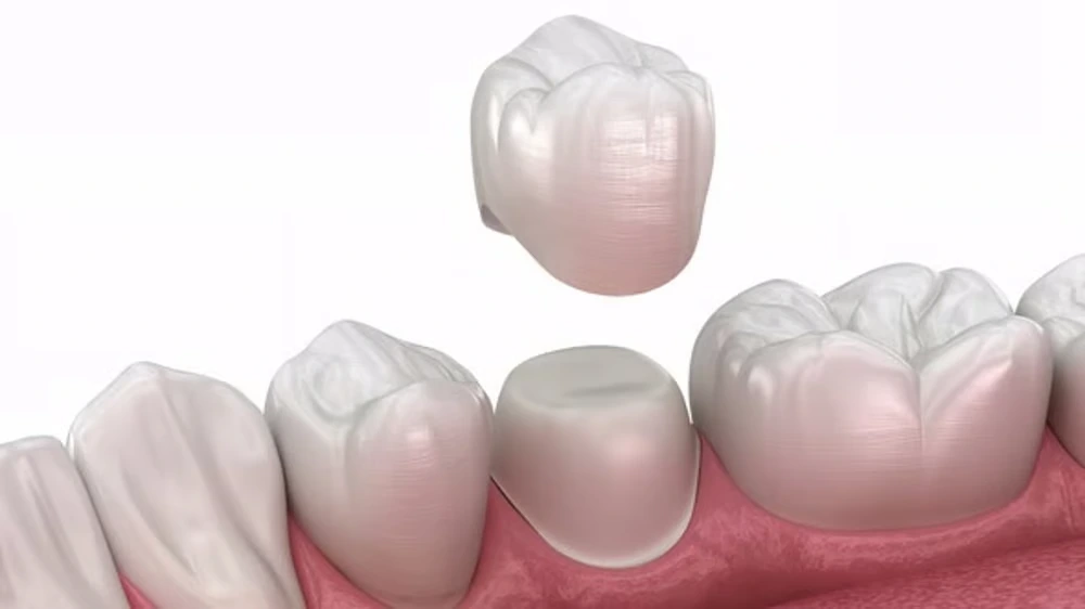 Zirconia Crowns: The Future of Dental Restorations