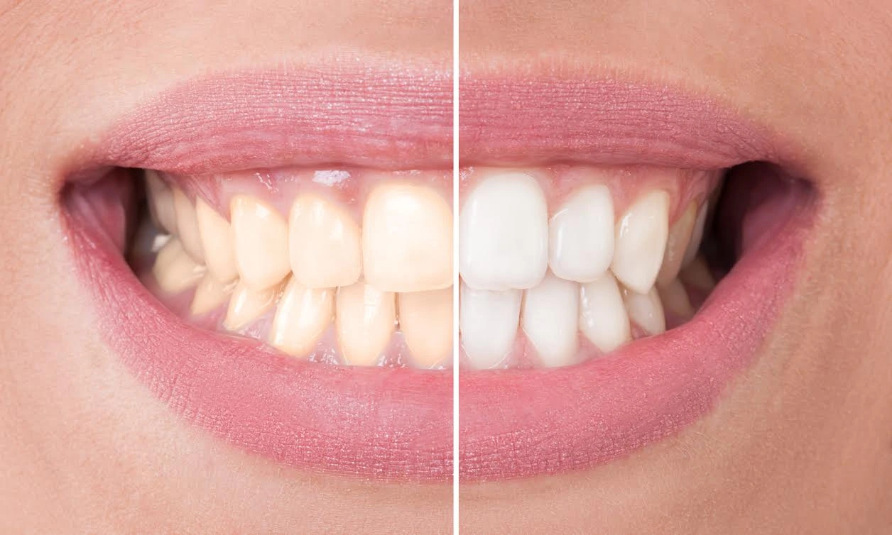 Nature’s Touch: Exploring Organic and Natural Whitening Methods