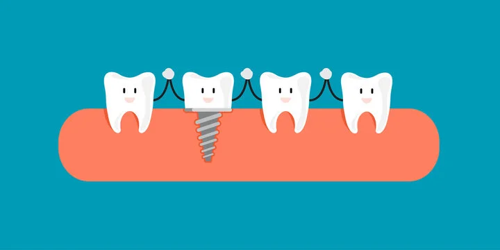 Immediate Dental Implants: The Fast Track to a New Smile