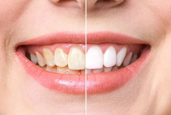 The Advantages of Teeth Whitening at a Dentist's Office
