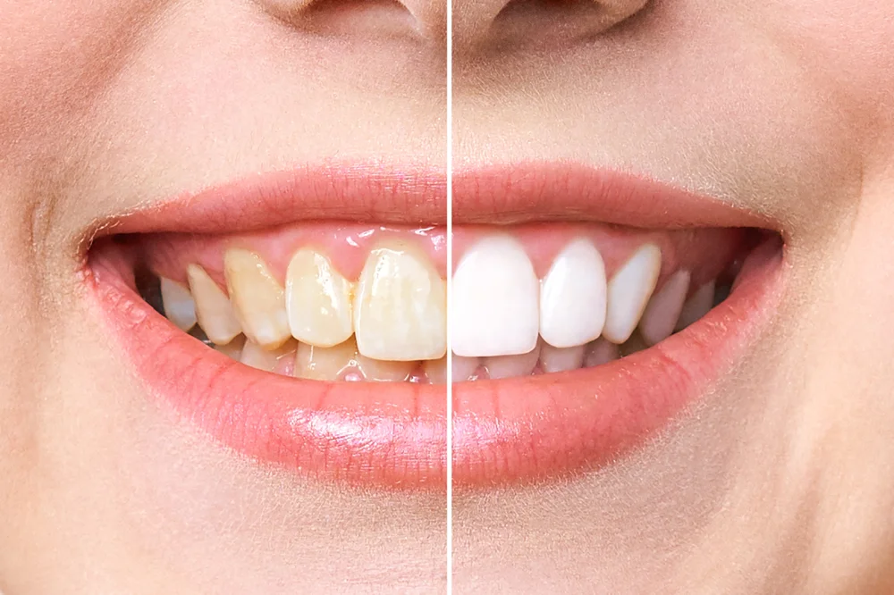 The Advantages of Teeth Whitening at a Dentist’s Office
